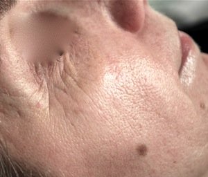 biostimolazione prima biostimolazione prima