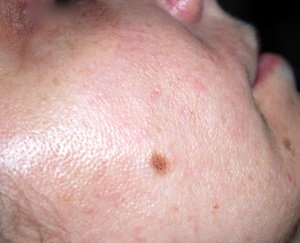 biostimolazione dopo biostimolazione dopo