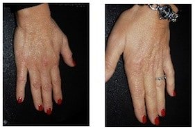 hands rejuvenation