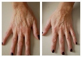 rejuvenation of hands