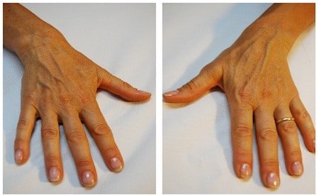 hands rejuvenation