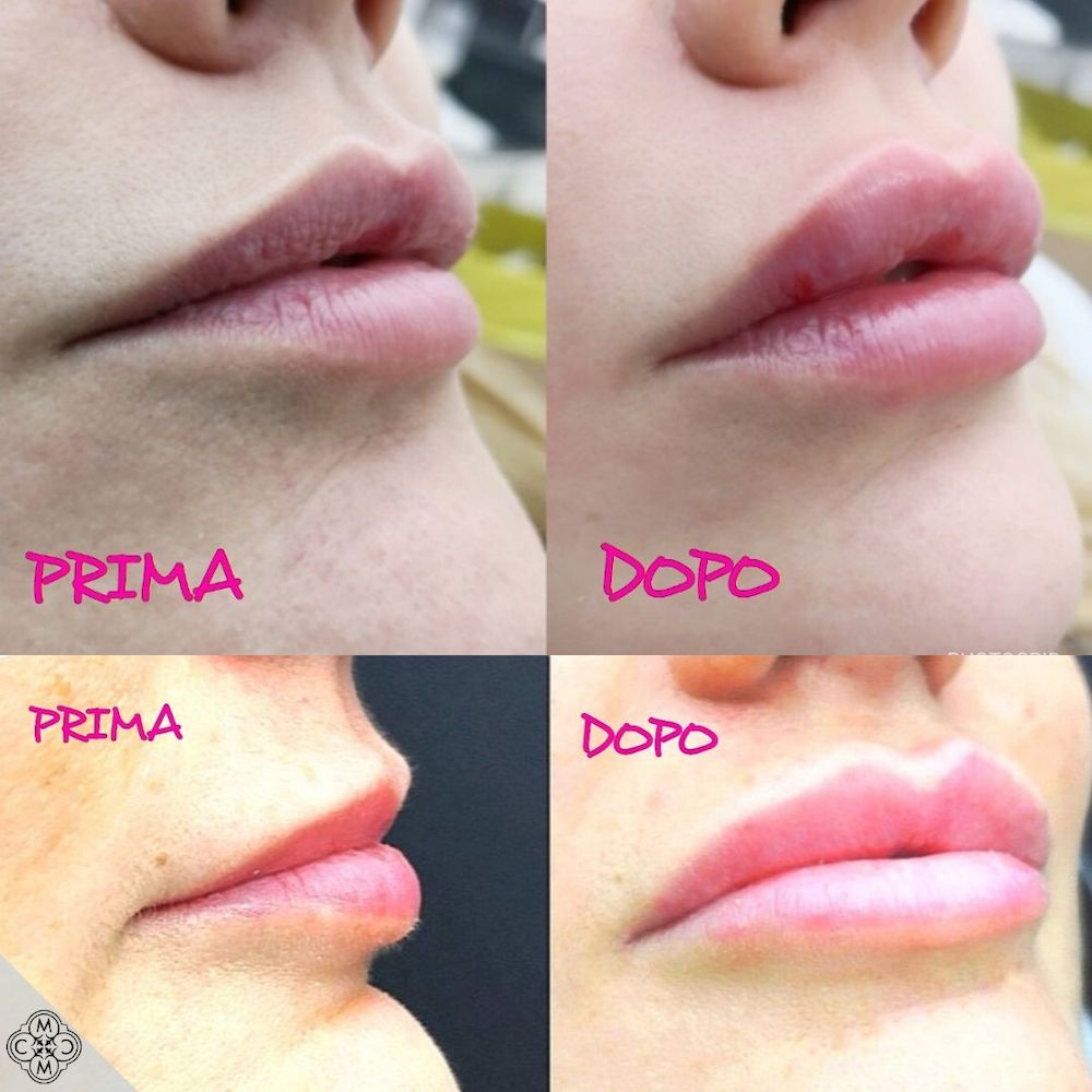 lip augmentation