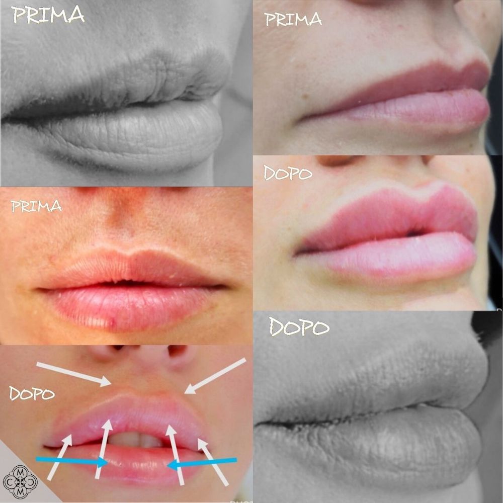 lip augmentation