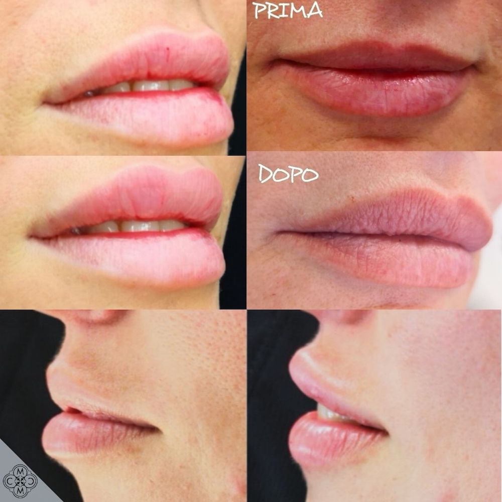 lip augmentation