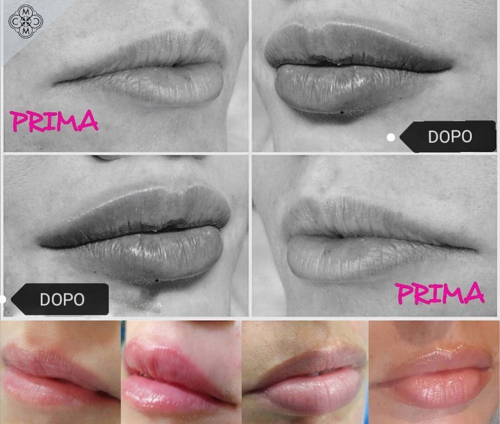 lip augmentation