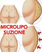 microliposuzione