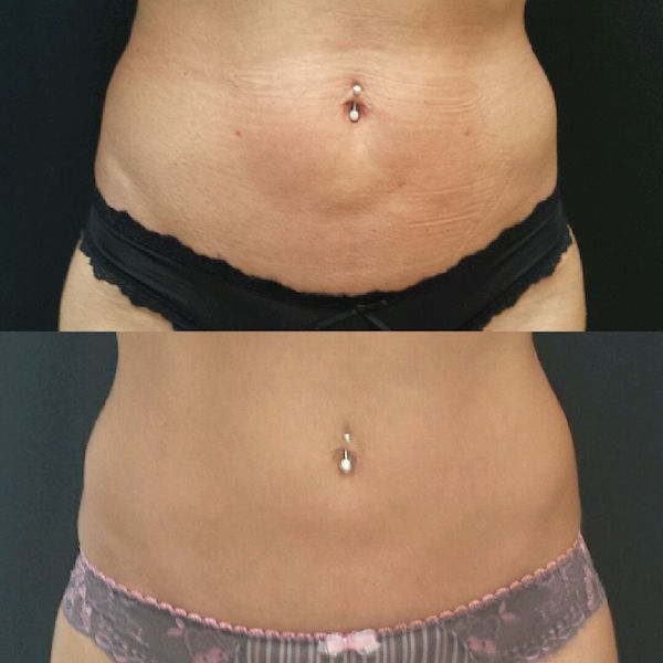 LIPOSCULTURA ADDOME