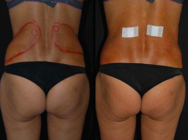 LIPOSCULTURA FIANCHI