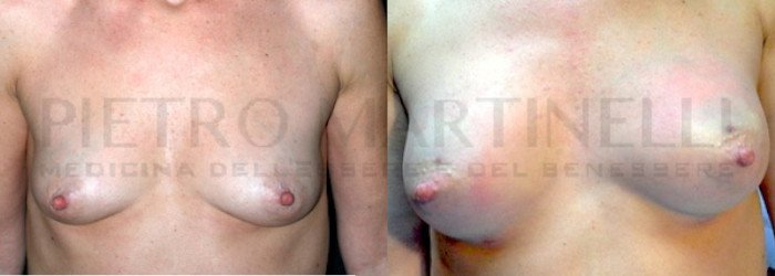 Lipofilling seno 11
