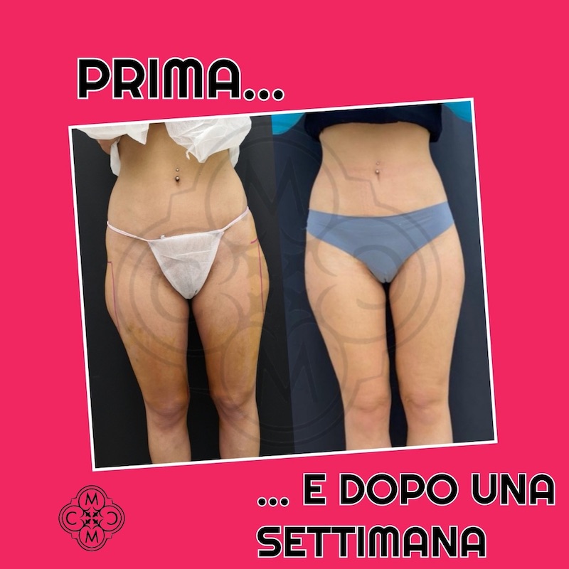 Liposcultura 10.12.20 2 martinelli