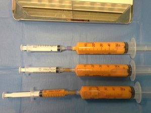 Grasso pronto per l'utilizzo lipofilling