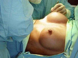 lipofilling seno lipofilling seno