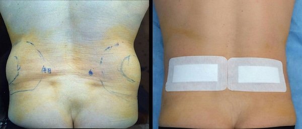 liposcultura fianchi prima e dopo