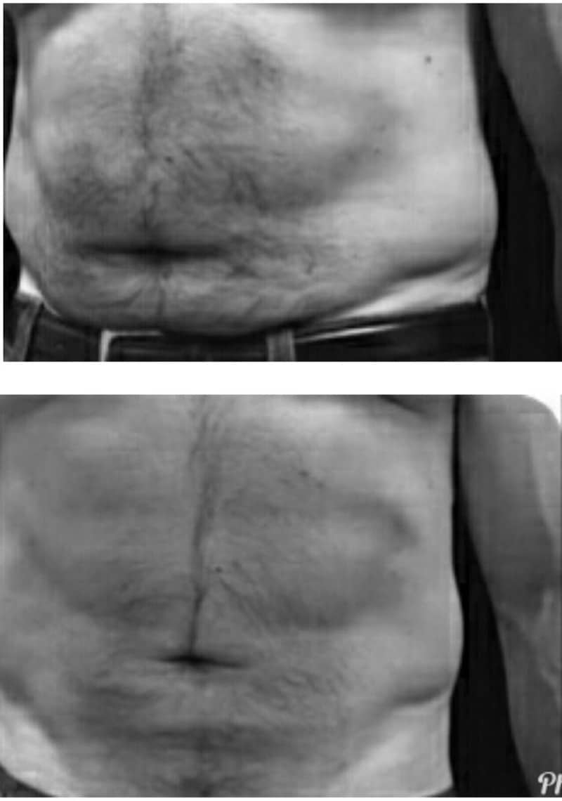 Liposcultura