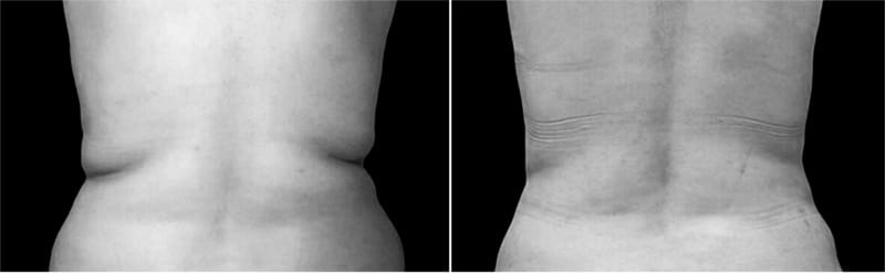 Liposcultura