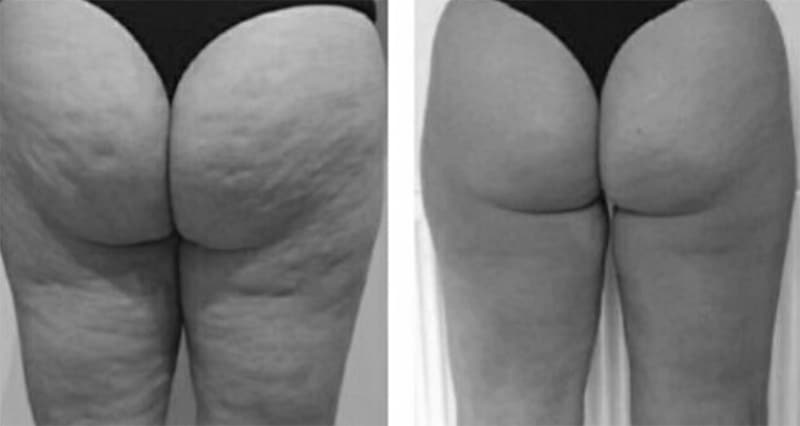 Liposcultura