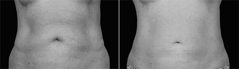 Liposcultura