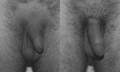 lipopenoscultura - prima e dopo il trattamento lipopenoscultura - prima e dopo il trattamento