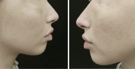Lower face profiloplasty and nose tip rotation - before after 1