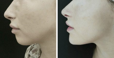 Lower face profiloplasty and nose tip rotation - before after 2