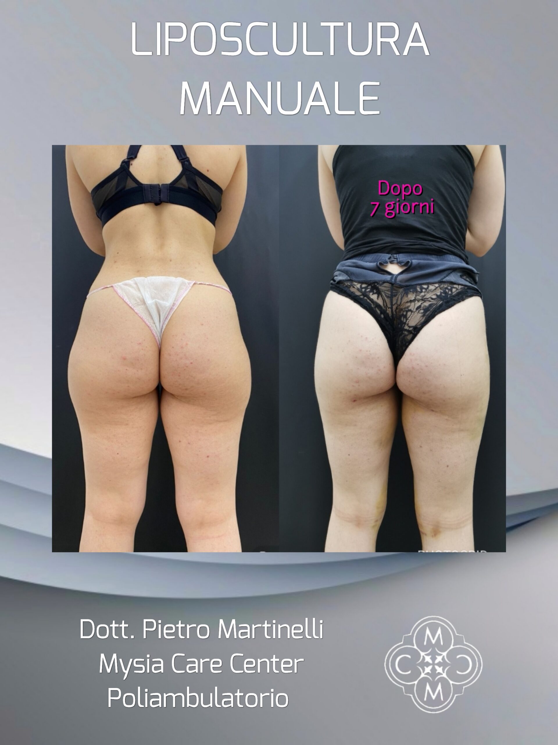 liposcultura manuale