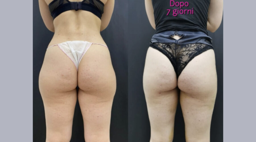liposcultura manuale