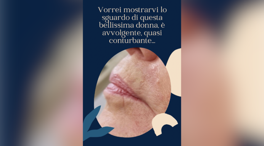 filler labbra dopo 70 anni