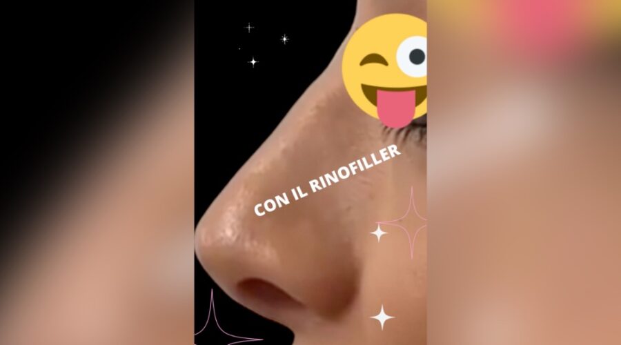 un altro risultato eclatante con il rinofiller