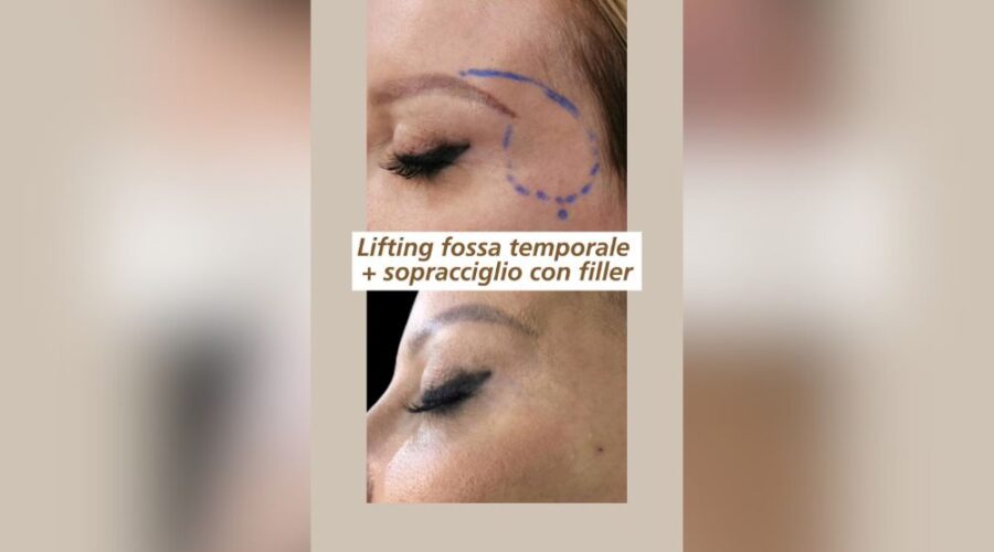 Lifting fossa temporale e filler al sopracciglio