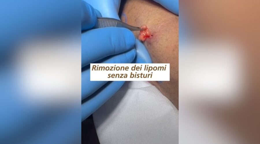Rimozione dei Lipomi Senza Bisturi