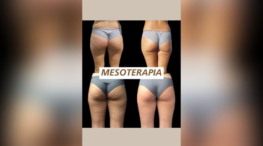 Scopri come combattere la cellulite
