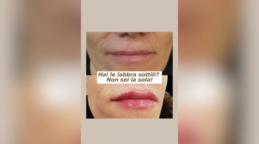 Come Affrontare le Labbra Sottili
