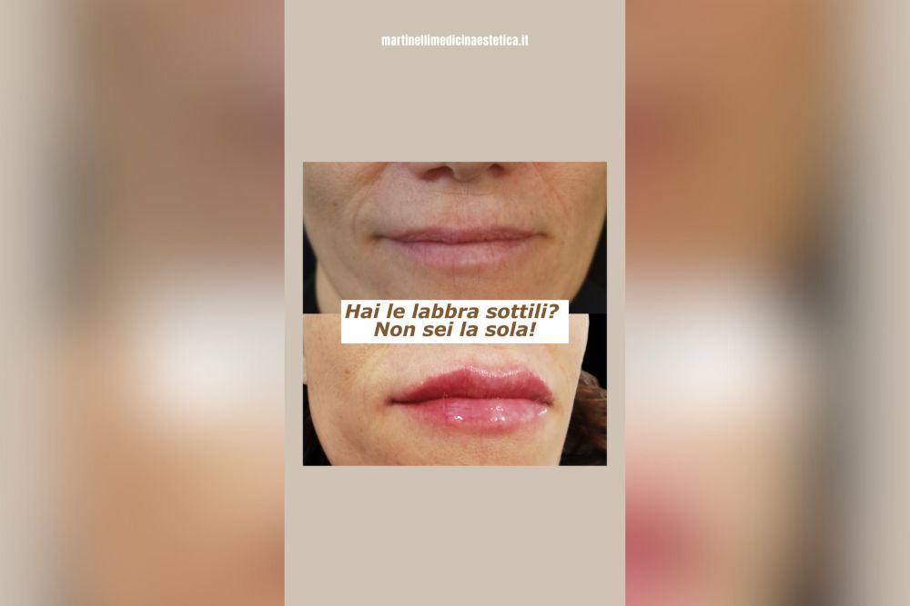 Come Affrontare le Labbra Sottili