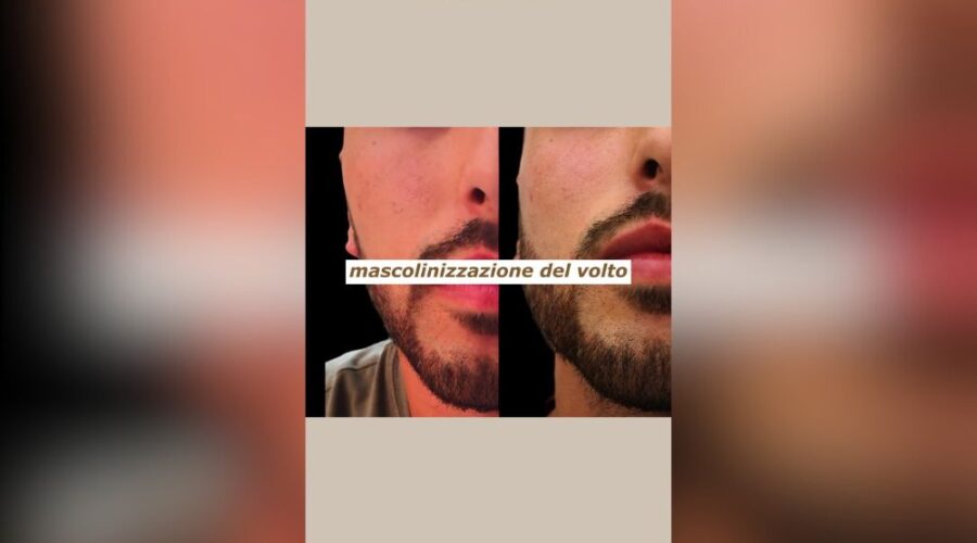 mascolinizzazione del volto