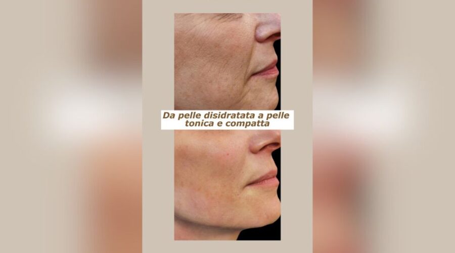 Il miracolo della biostimolazione da pelle stanca a splendente