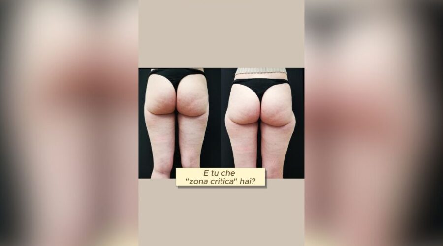 conosci la liposcultura manuale
