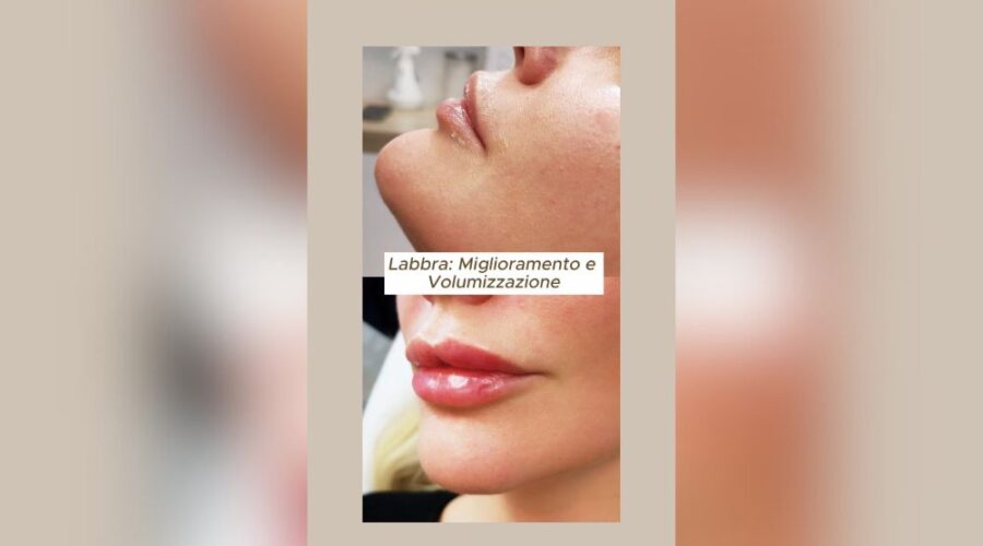 Ecco come ho migliorato le labbra di questa paziente