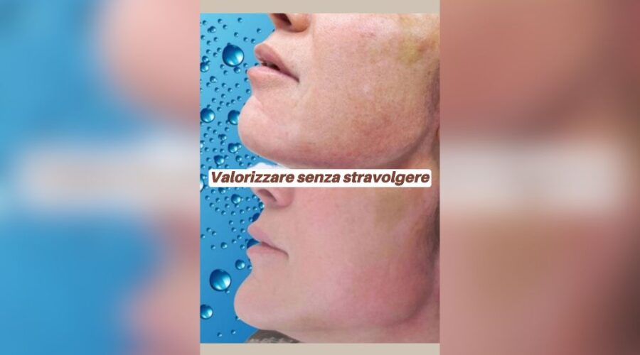 Profiloplastica & Lifting Liquido: Come Valorizzare il Tuo Viso Senza Stravolgerlo