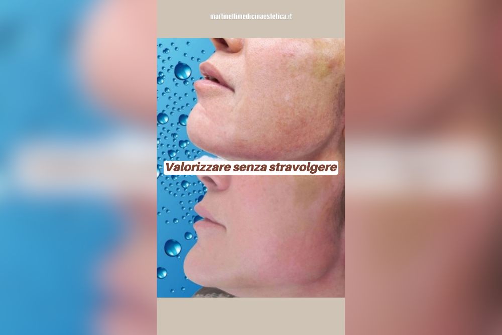 Profiloplastica & Lifting Liquido: Come Valorizzare il Tuo Viso Senza Stravolgerlo