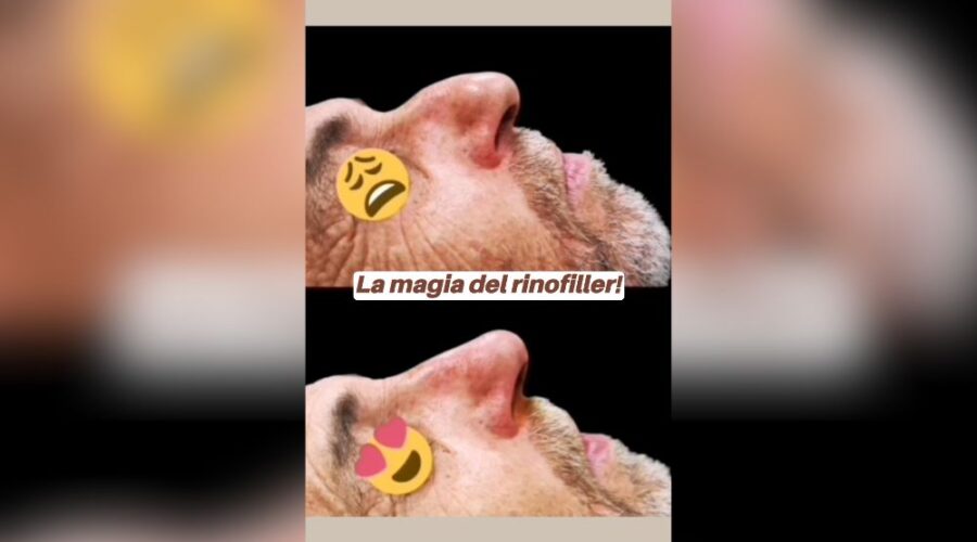 Segreto del rinofiller come ho risolto un problema senza chirurgia