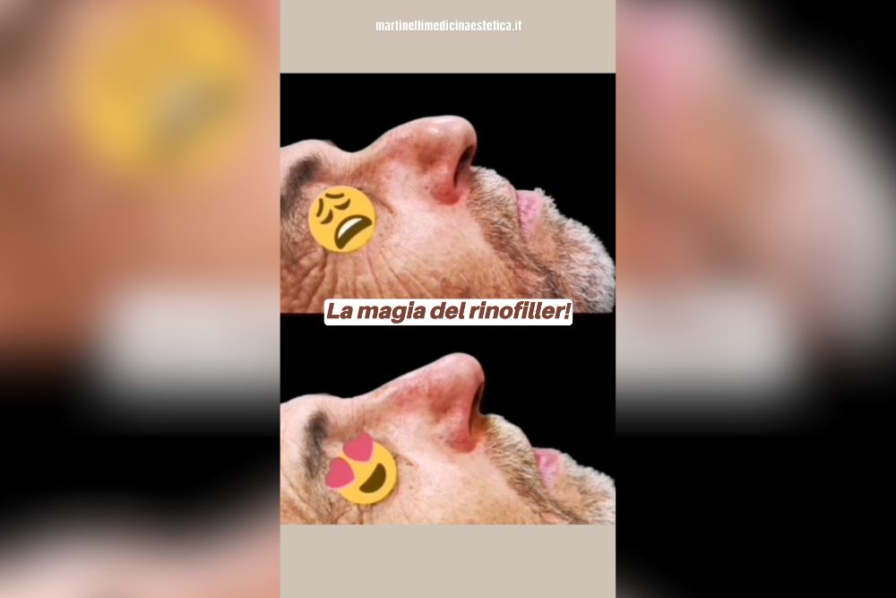 Segreto del rinofiller come ho risolto un problema senza chirurgia
