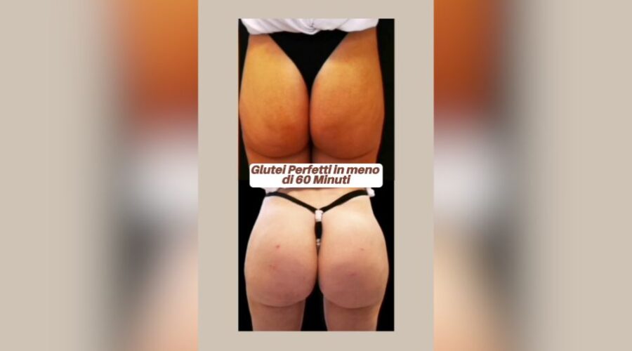 Aumento volumetrico dei glutei con filler
