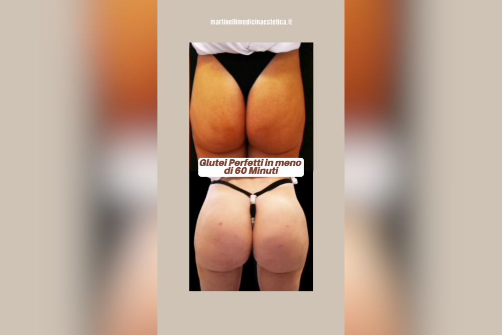 Aumento volumetrico dei glutei con filler