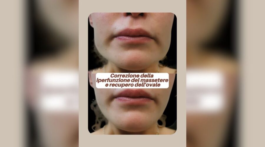 Correzione dell’iperfunzione del massetere