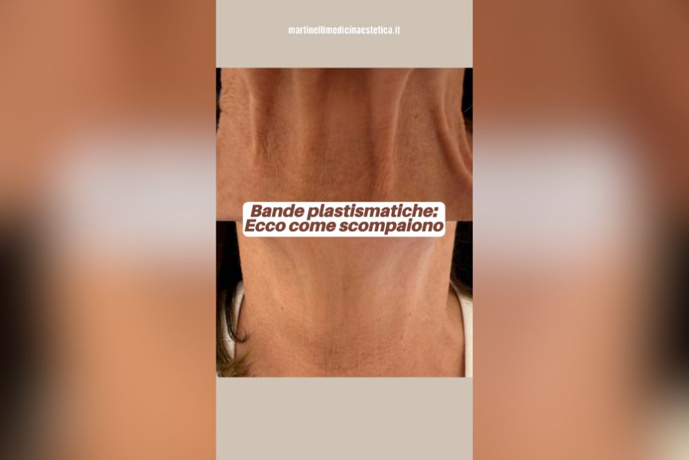 Trattamento delle bande platismatiche
