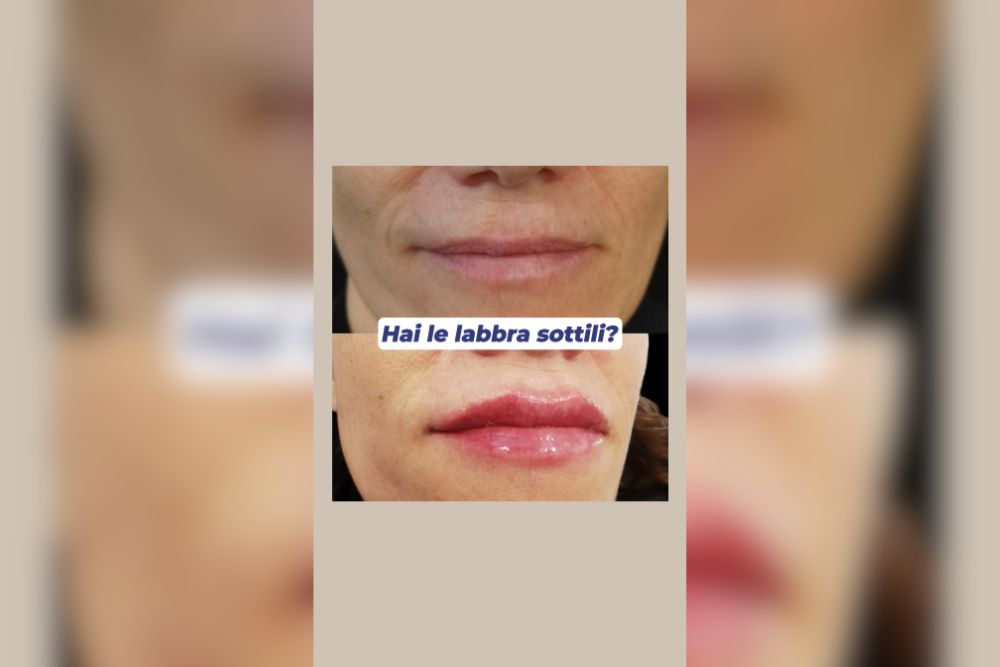 Filler su labbra molto sottili perché la gradualità è la chiave per un risultato naturale